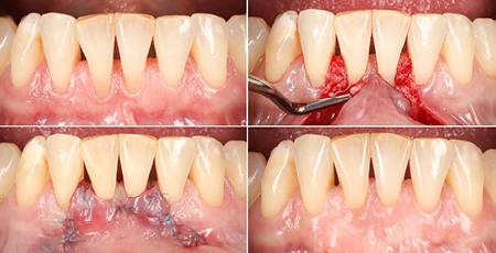 Treatment of challending mandibular anterior recessions