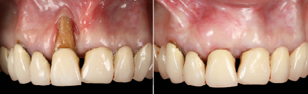 severe gingival recession treated with a laterally moved coronally advanced flap